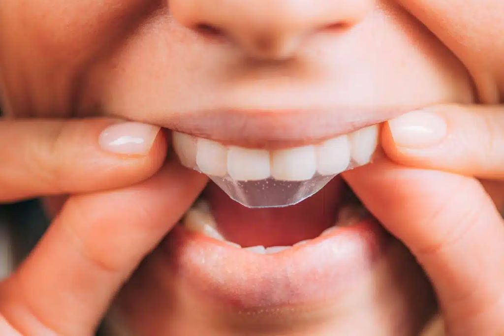 Do Whitening Strips Work? The Truth About That Brighter Smile